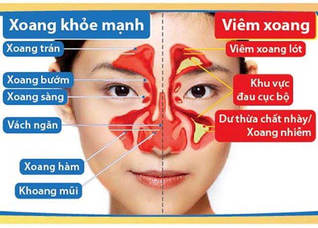 TRIỆU CHỨNG VIÊM XOANG